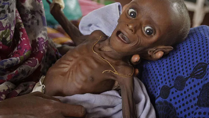 BM: Somali’de 200 çocuk açlıktan öldü!