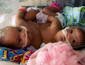 4 aylık yapışık ikizler Teksas hastanesinde  ameliyatla ayrıldı
