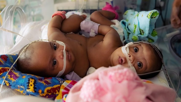 4 aylık yapışık ikizler Teksas hastanesinde  ameliyatla ayrıldı