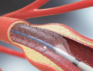 Türk doktor ve mühendislerinden “stent-greft” alanında büyük başarı