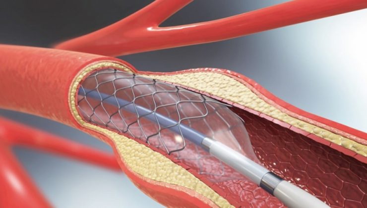 Türk doktor ve mühendislerinden “stent-greft” alanında büyük başarı