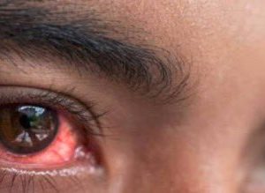 Bulaşıcı ‘kırmızı göz’ hastalığı hızla yayılıyor: Sayı 86 bini geçti