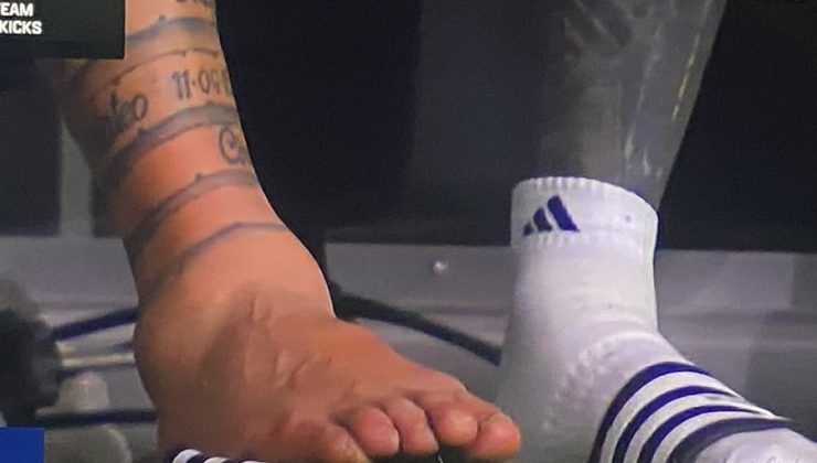 Messi’nin ayağı böyle şişti! Dayanılmaz bir acı!